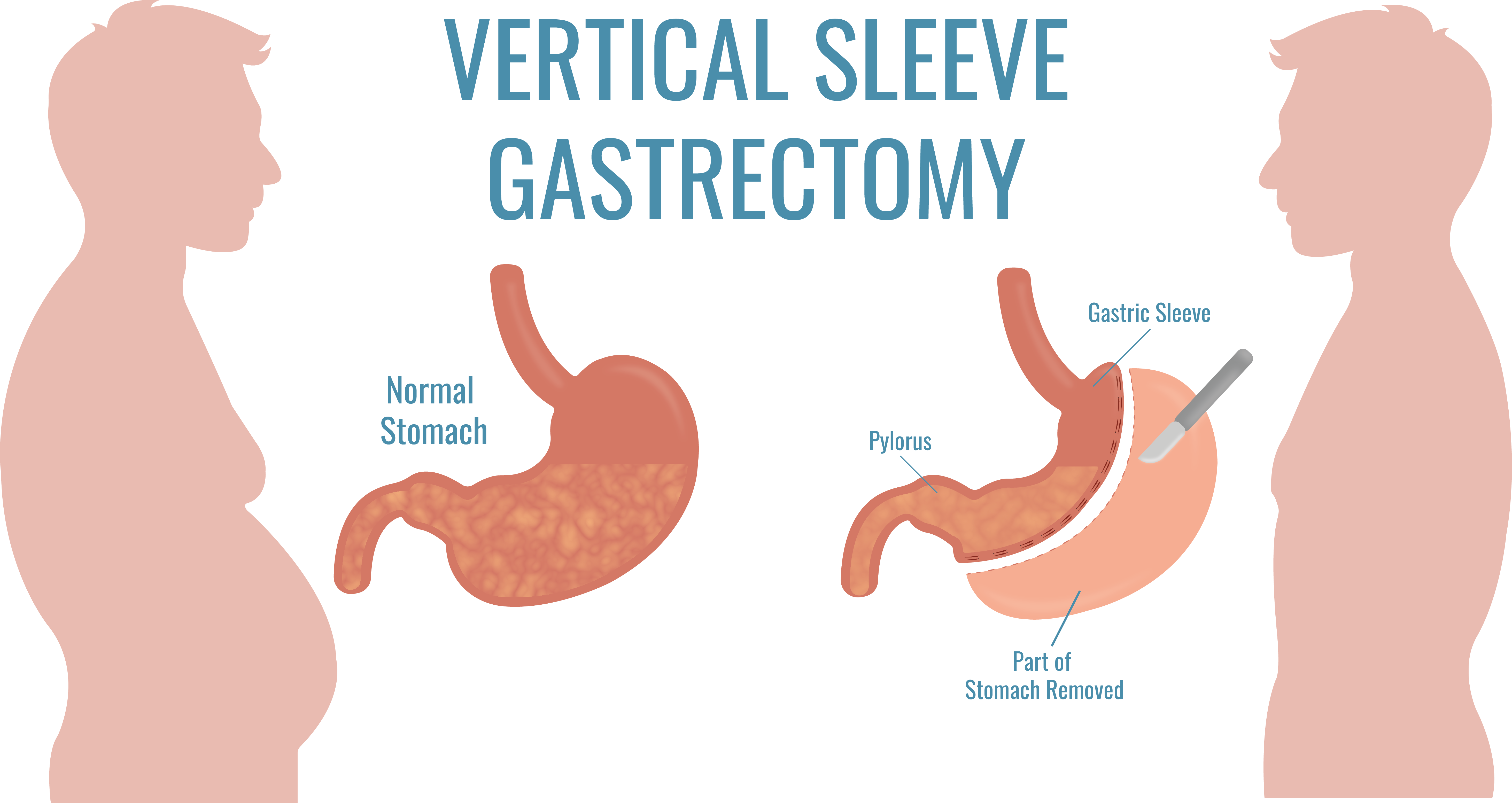 Gastric Bypass Vs Gastric Sleeve Compare Procedures 2022 