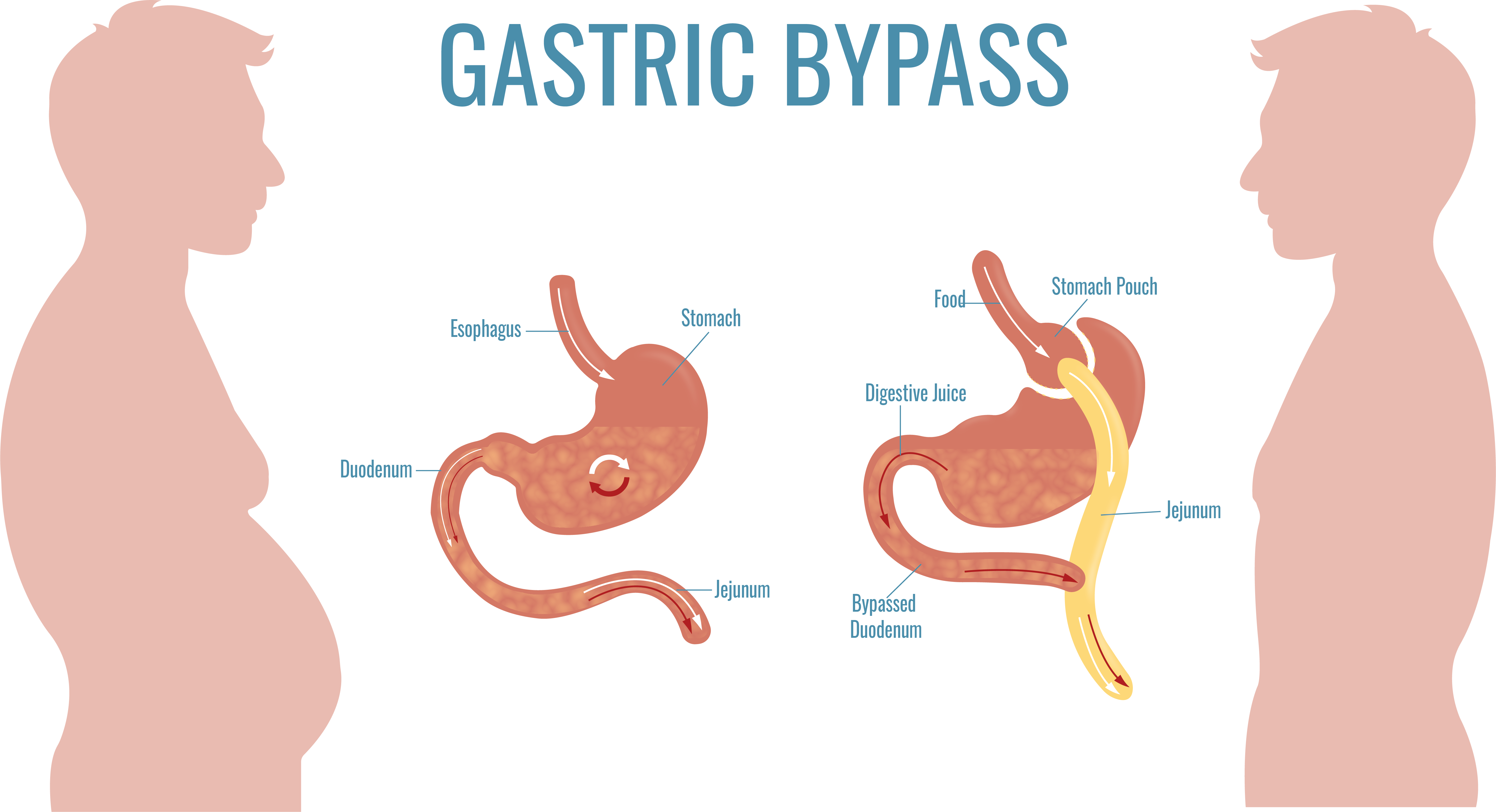 Gastric Bypass Vs Gastric Sleeve Compare Procedures 2022 