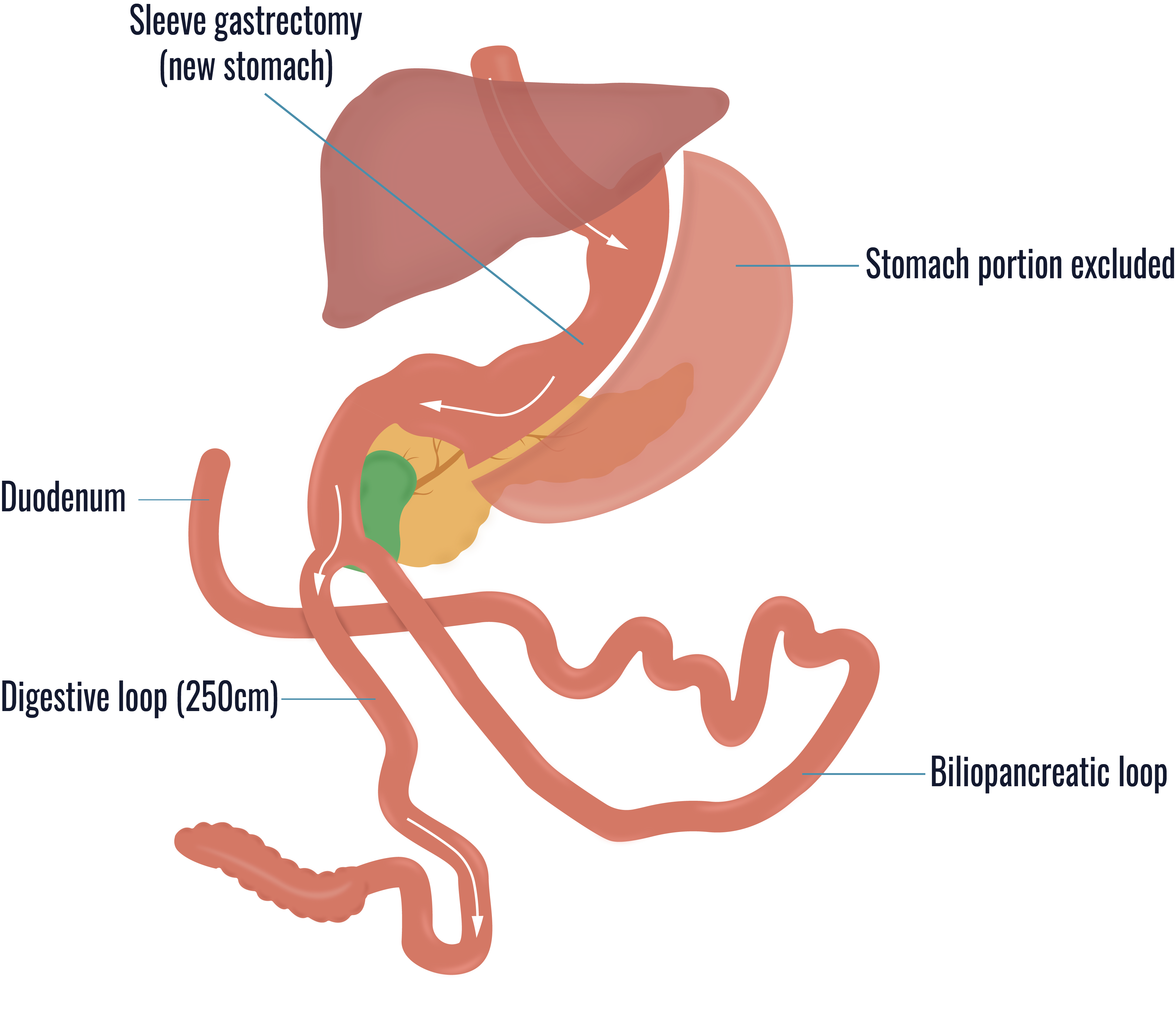 SADI-S Bariatric Surgery