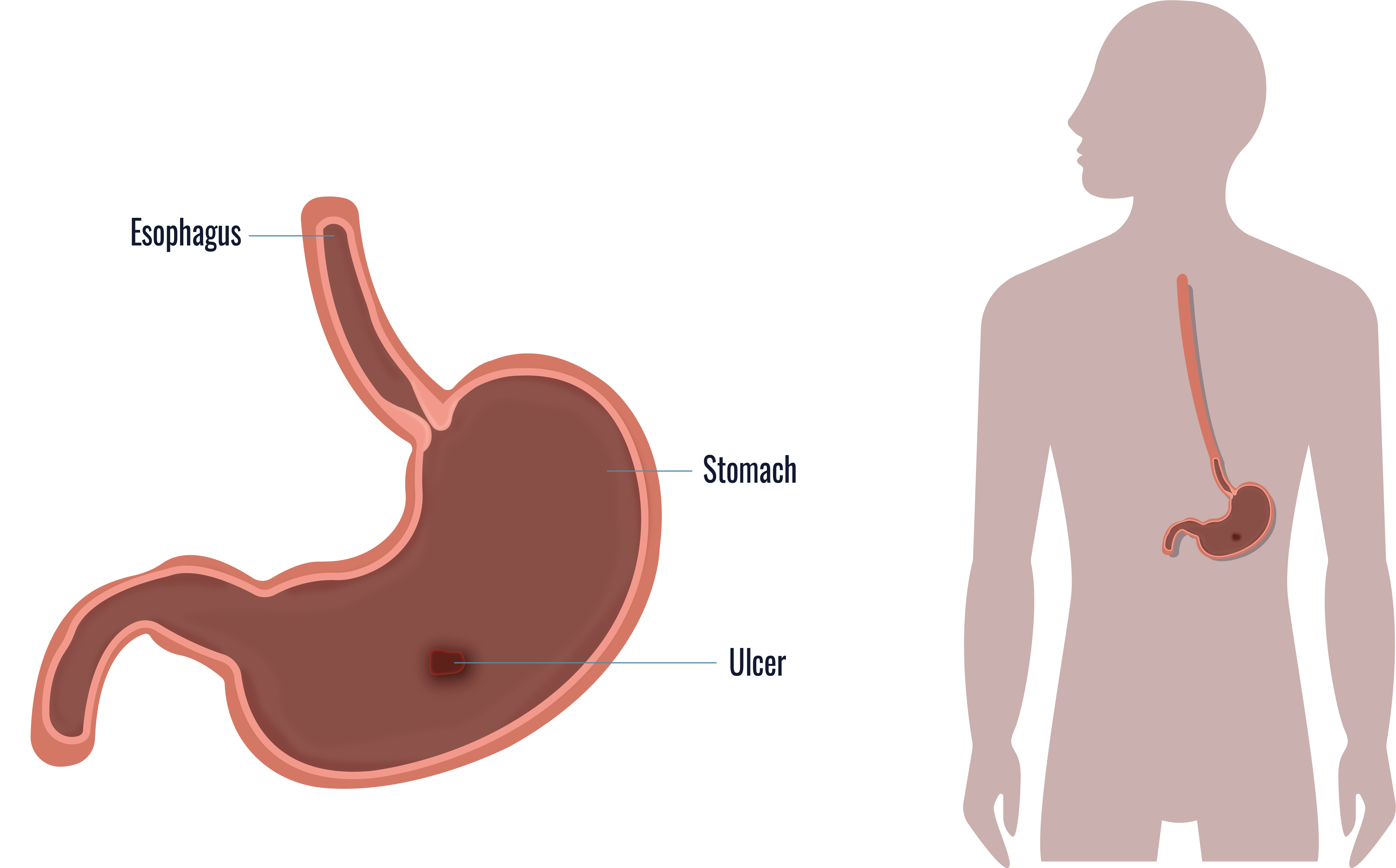 Bariatric Surgery Risks All Pros And Cons Of Weight Loss Surgery Dr Ceyhun Aydoğan 