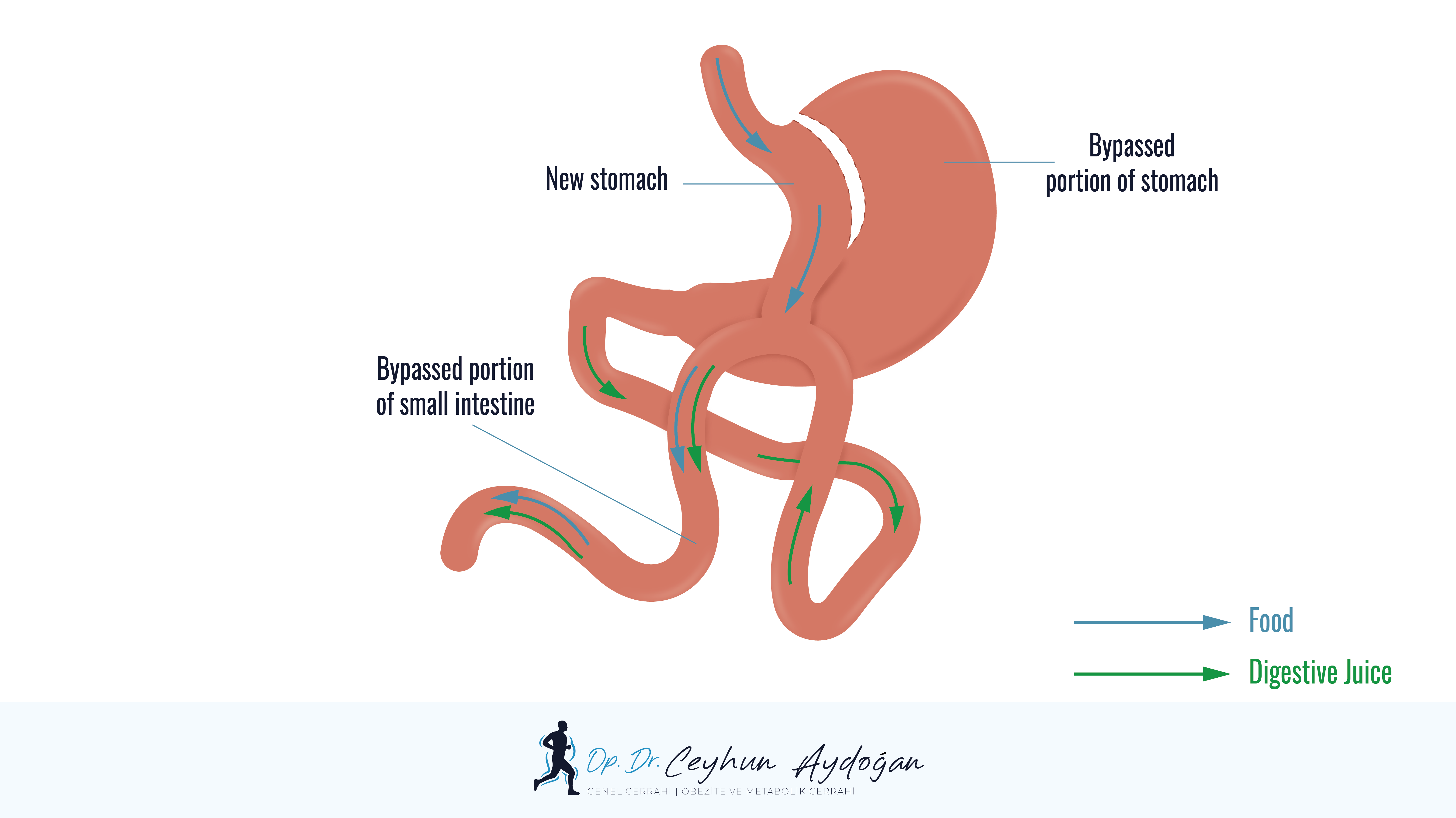 Mini Gastric Bypass