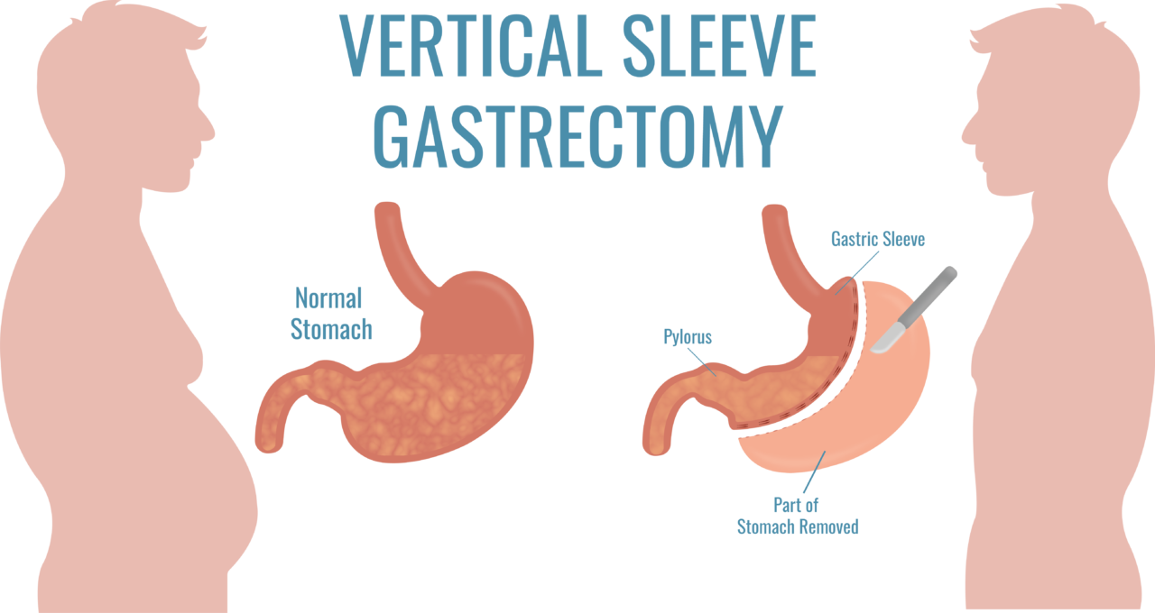 Gastric Bypass vs Gastric Sleeve: Compare Procedures