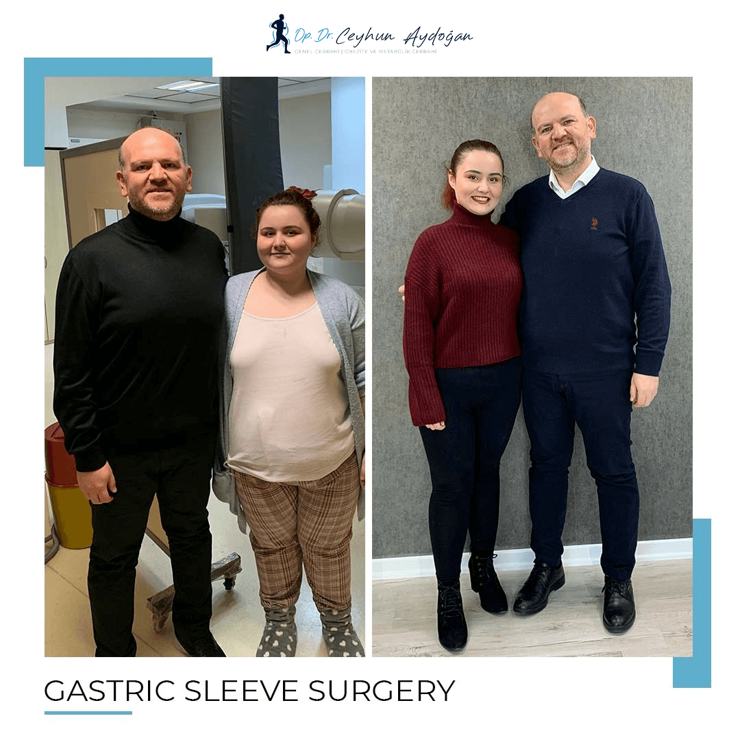 gastric sleeve turkey before and after patient 3