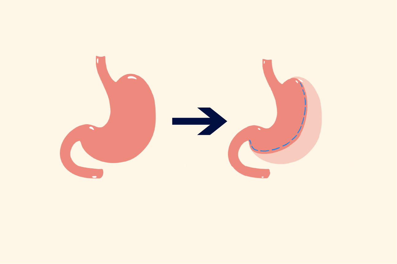 Gastric Sleeve - Dr. Ceyhun Aydoğan