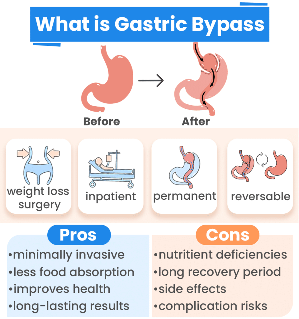 Gastric Bypass Surgery: How It Works, Benefits & Drawbacks