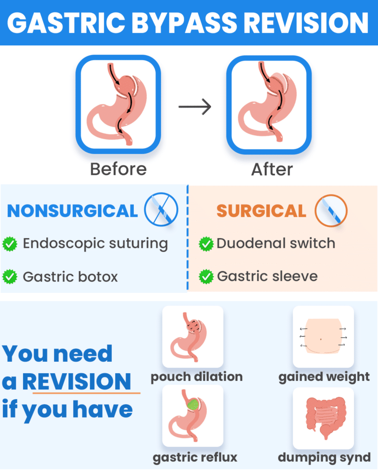 Gastric Bypass Revision Why And When To Get One 1475