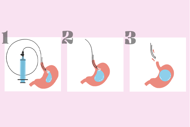 Gastric-balloon-surgery