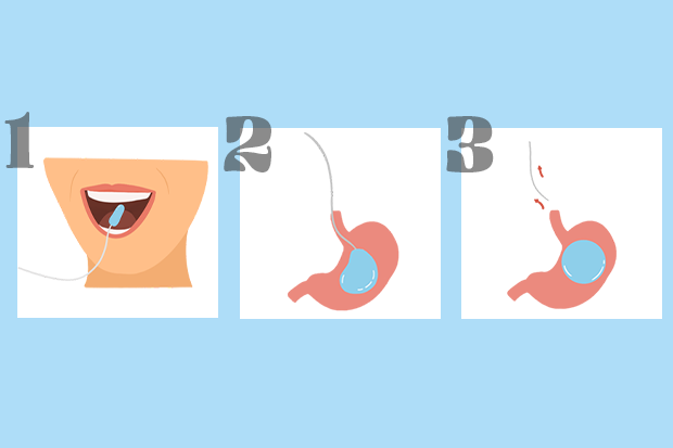 gastric-balloon-pill